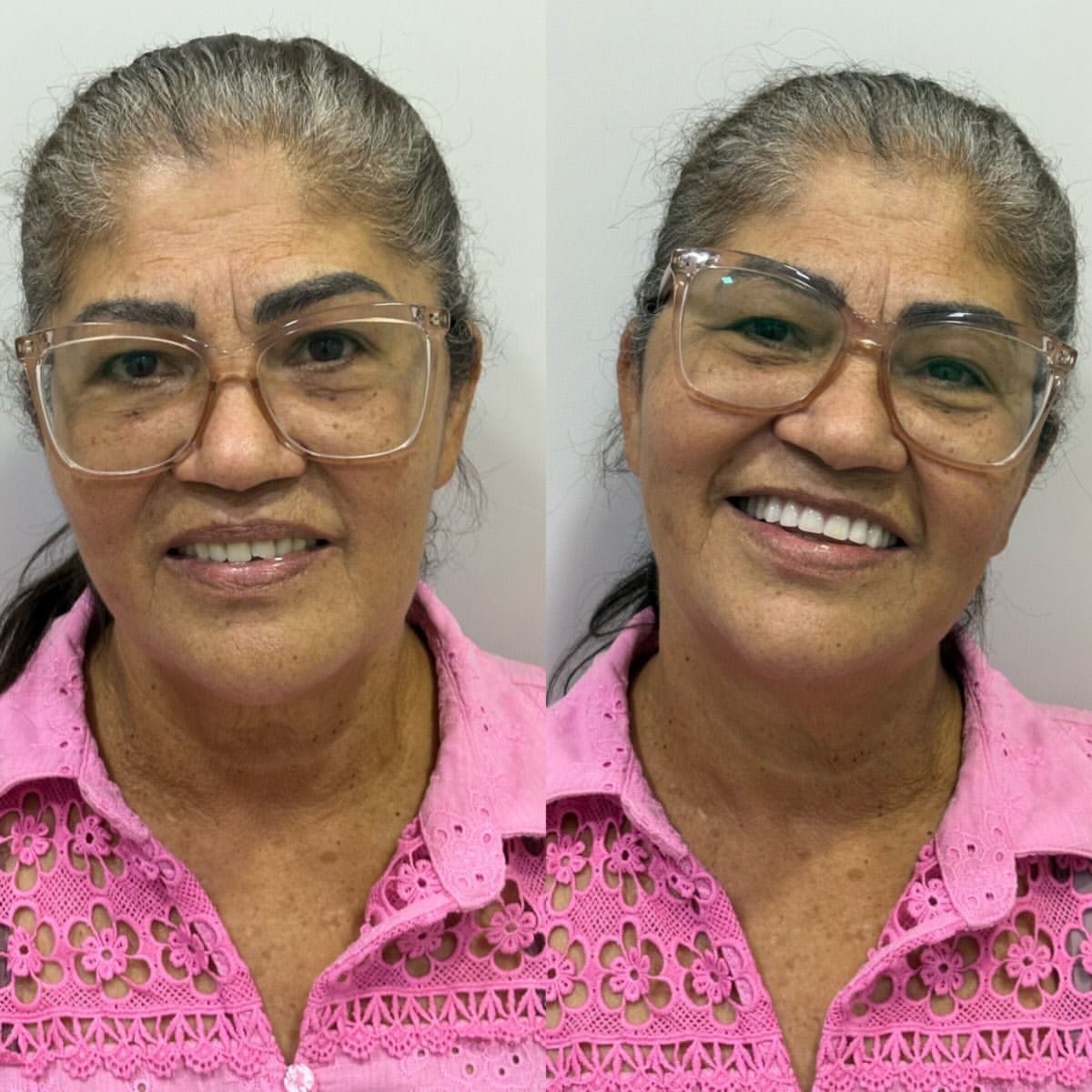 Resultado de tratamento — antes e depois