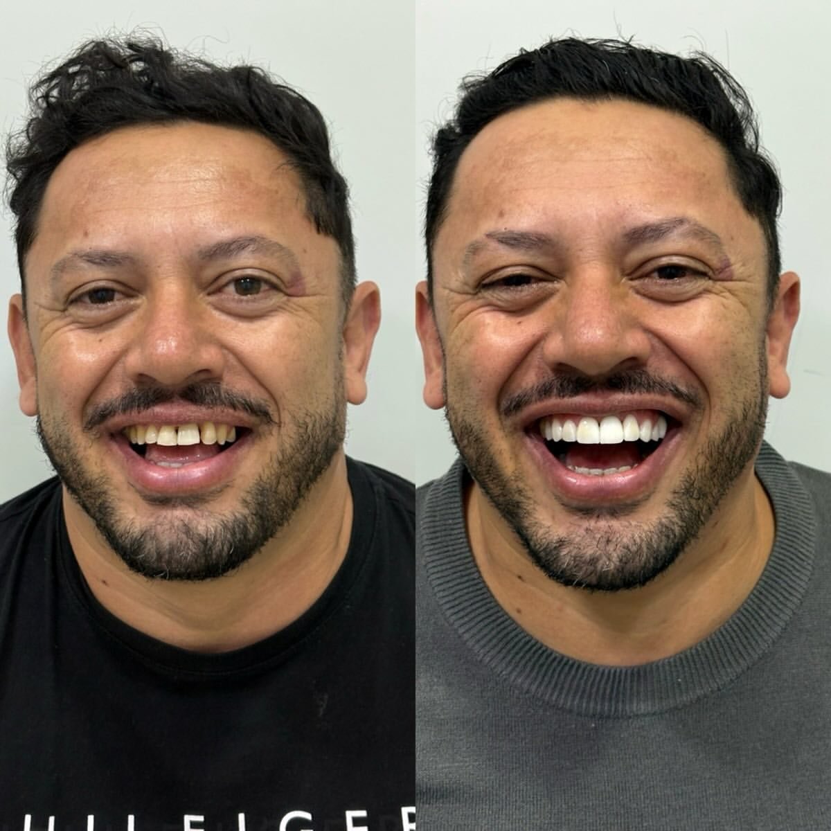Resultado de tratamento — antes e depois