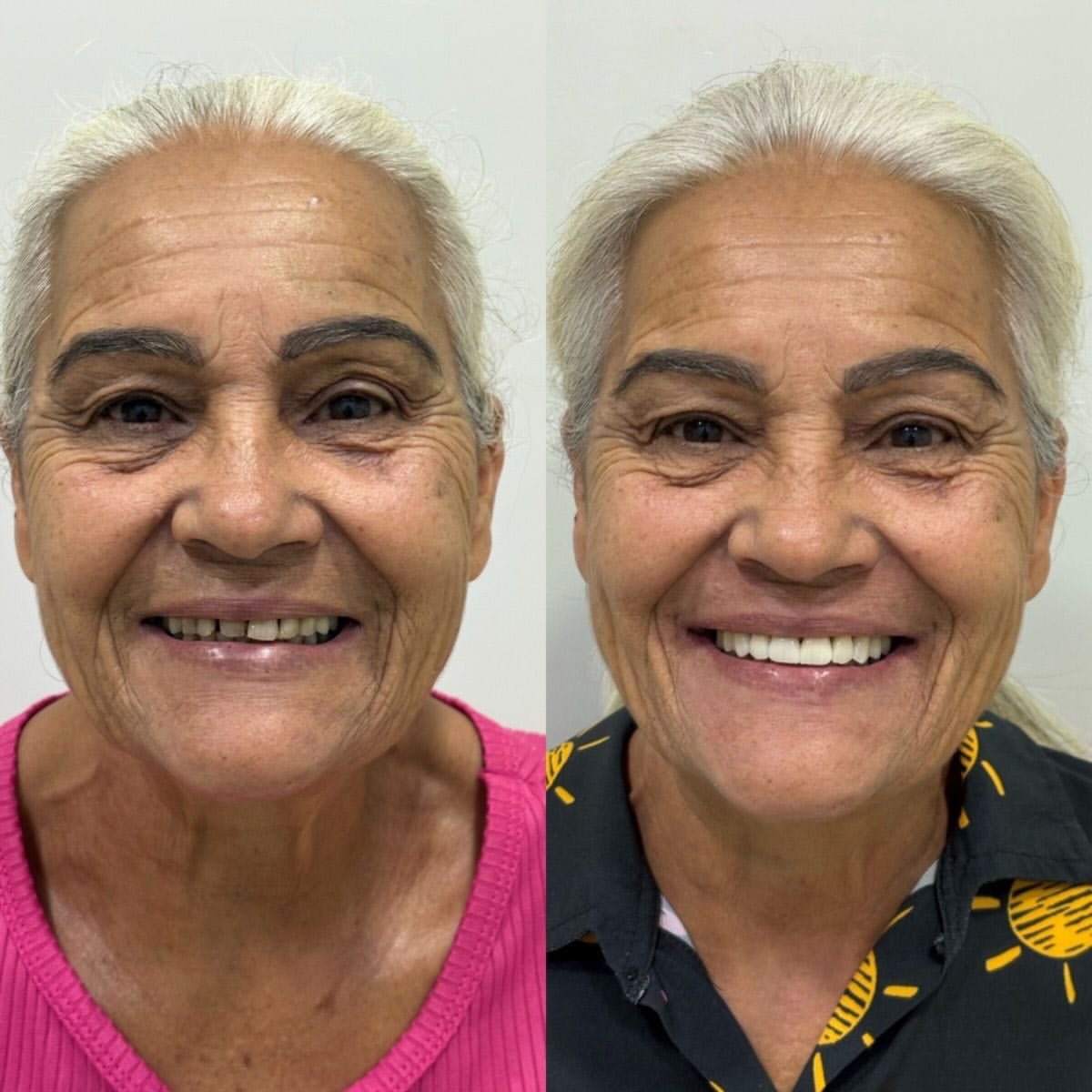 Resultado de tratamento — antes e depois